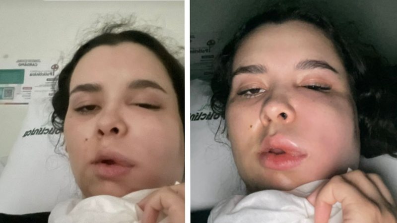 A retirada dos dentes do siso de Ana Luiza evoluíram para um quadro de infecção. - Imagem: reprodução/TikTok @anarenosto.1