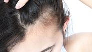 Penteados muito apertados podem ser uma das causas de dor no couro cabeludo. - Mintra Kwthijak / istock