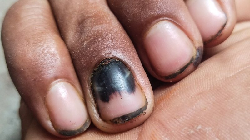 Veja os motivos do surgimento de manchas pretas nas unhas e como evitar. - echnical Bhadresh / istock