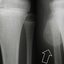 Entenda a gravidade do tumor osteocondroma. - reprodução/ divulgação