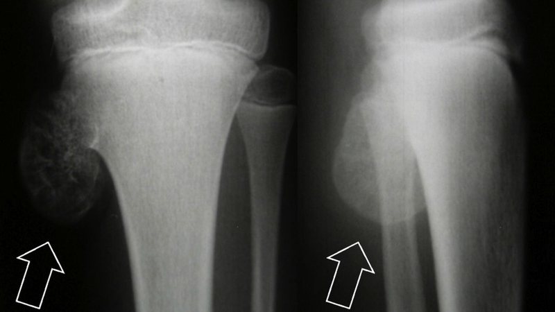 Entenda a gravidade do tumor osteocondroma. - reprodução/ divulgação