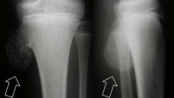 Entenda a gravidade do tumor osteocondroma. - reprodução/ divulgação